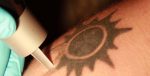 Πως αφαιρείται ένα τατουάζ με λέιζερ (Video)